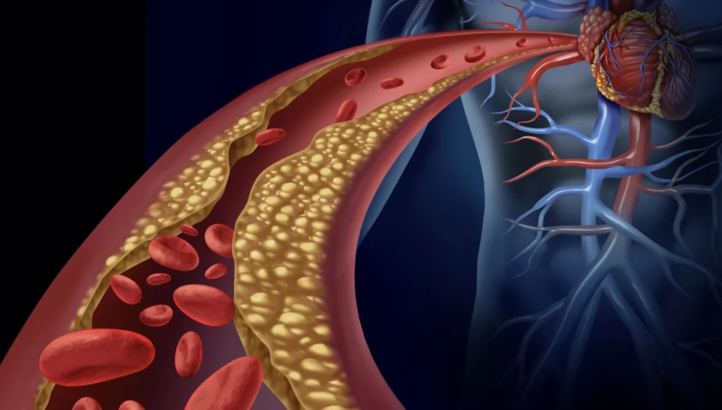 Ilustración médica que muestra una arteria parcialmente bloqueada por placas de colesterol, lo que representa una condición de aterosclerosis. Se visualizan glóbulos rojos fluyendo por el vaso sanguíneo estrechado y su conexión con el corazón humano.
