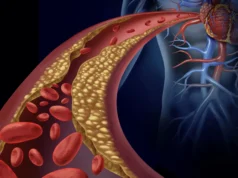 Nanopartículas cazaplacas detectan y desarman la principal causa de enfermedades cardíacas Ilustración médica que muestra una arteria parcialmente bloqueada por placas de colesterol, lo que representa una condición de aterosclerosis. Se visualizan glóbulos rojos fluyendo por el vaso sanguíneo estrechado y su conexión con el corazón humano.