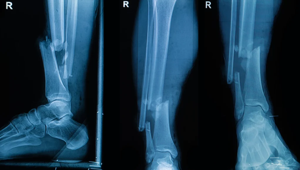 Radiografías médicas de una pierna derecha en tres vistas diferentes, mostrando una fractura grave en los huesos de la tibia y el peroné cerca del tobillo.